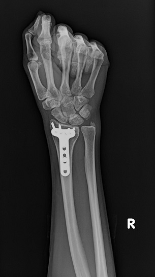 hand wrist fracture
